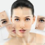 Savjeti i preporuke za borbu protiv akni