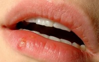 herpes_resize