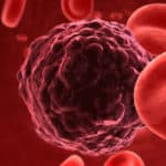 Miom – blagi tumor