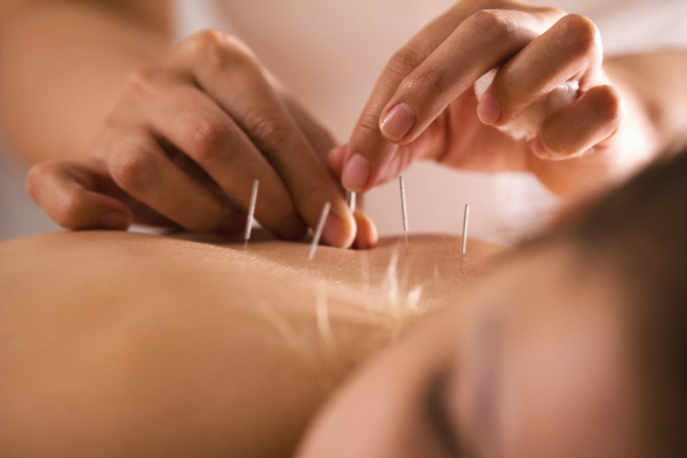 akupunktura je jedna od metoda koje liječe uklještenje živca u leđima